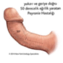 Peyronie hastalığı