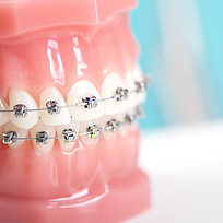Orthodontic Fixed Braces