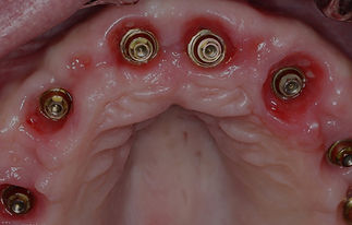 Implant_red.jpg