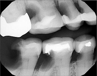 Root_Caries.jpg