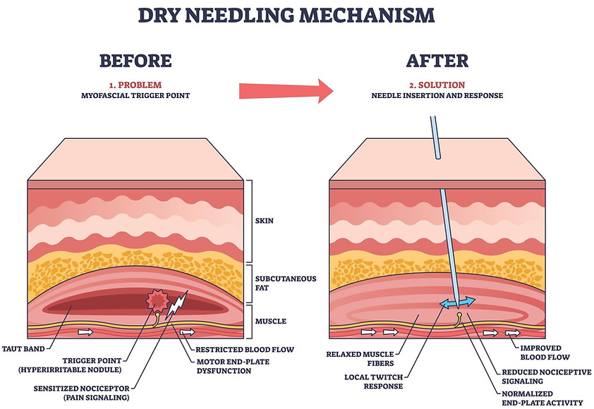 Dry needling for trigger point release muscular pain and improved movement