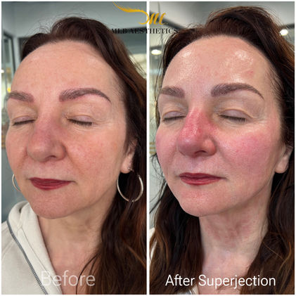 pdrn salmon dna microneedling facial arizona