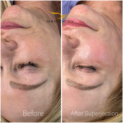 superjection microneedling with exosomes , korean glass skin, glowy skin, scottsdale arizona