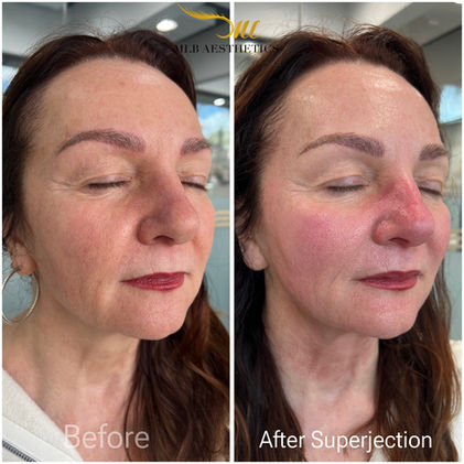 pdrn salmon sperm facial scottsdale az