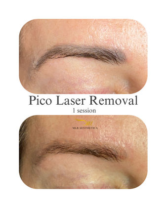 eyebrow pico laser removal