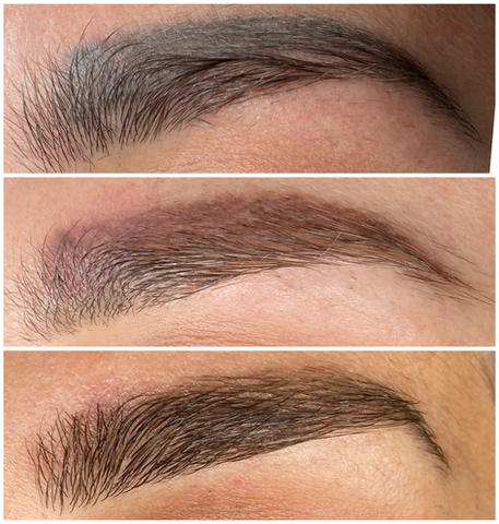 Laser tattoo removal arizona, picosure, eyebrow removal, saline removal