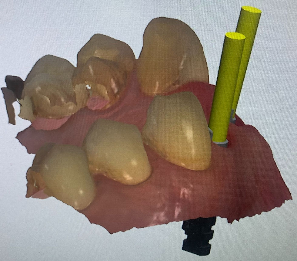 Implant Angles