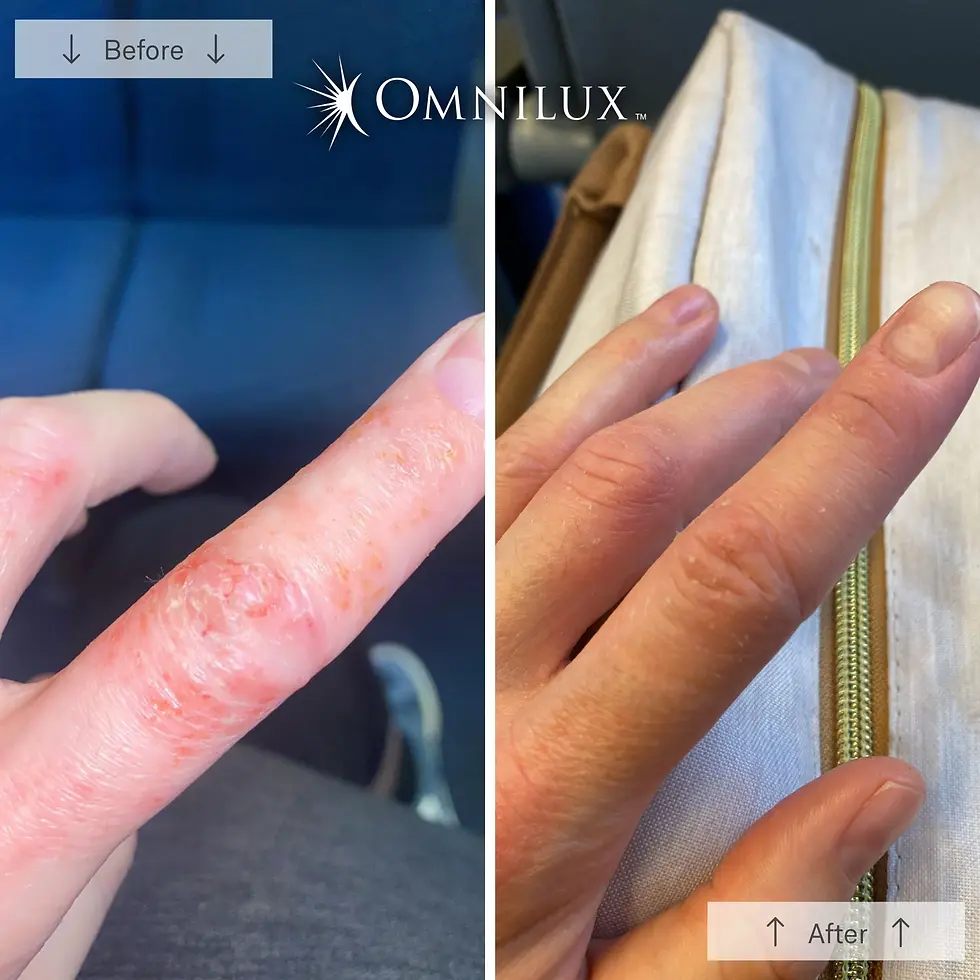 Thumbnail: Omnilux Contour Glove