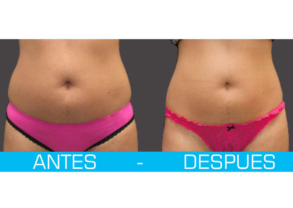 antesdesplipilaser