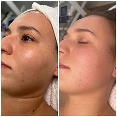 Japanese face massage - before and after