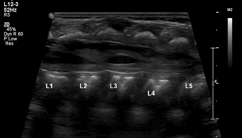 Filar Cyst on Lumbar Spine Ultrasound