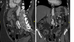 Leriche Syndrome