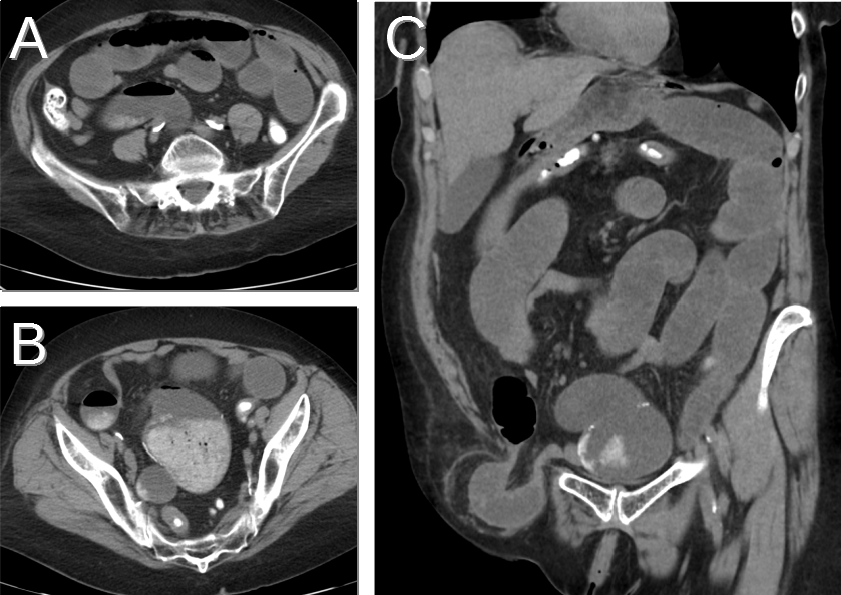 CT of SBO Due to Incarcerated Inguinal Hernia