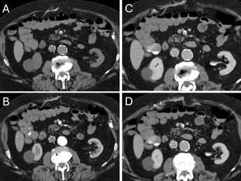 Active Bleeding in the Ascending Colon