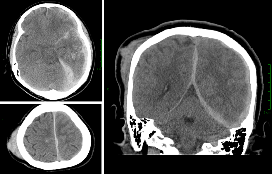 Contrecoup Brain Injury