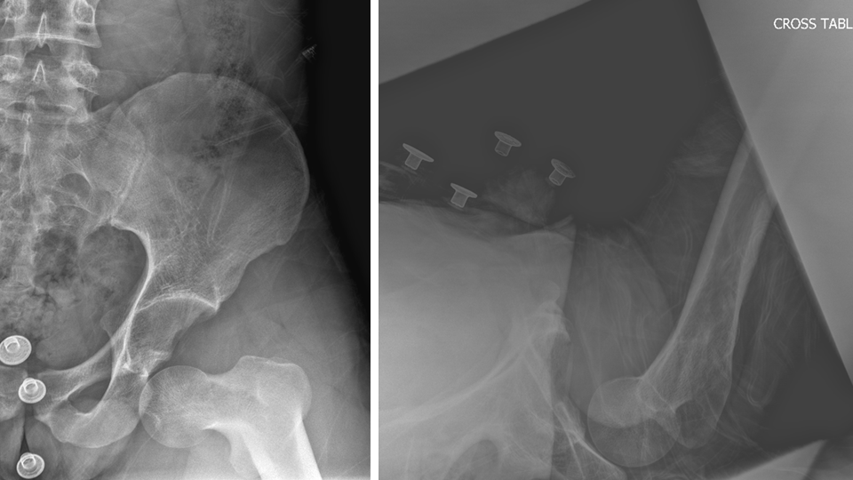 Inferior Hip Dislocation Xray
