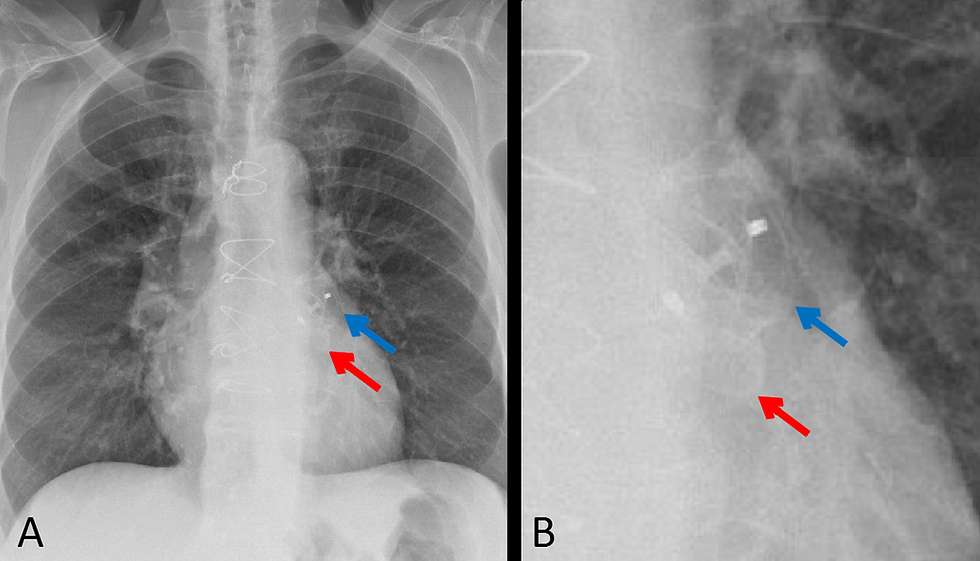Chest Xray of Amulet® device from St. Jude Medical