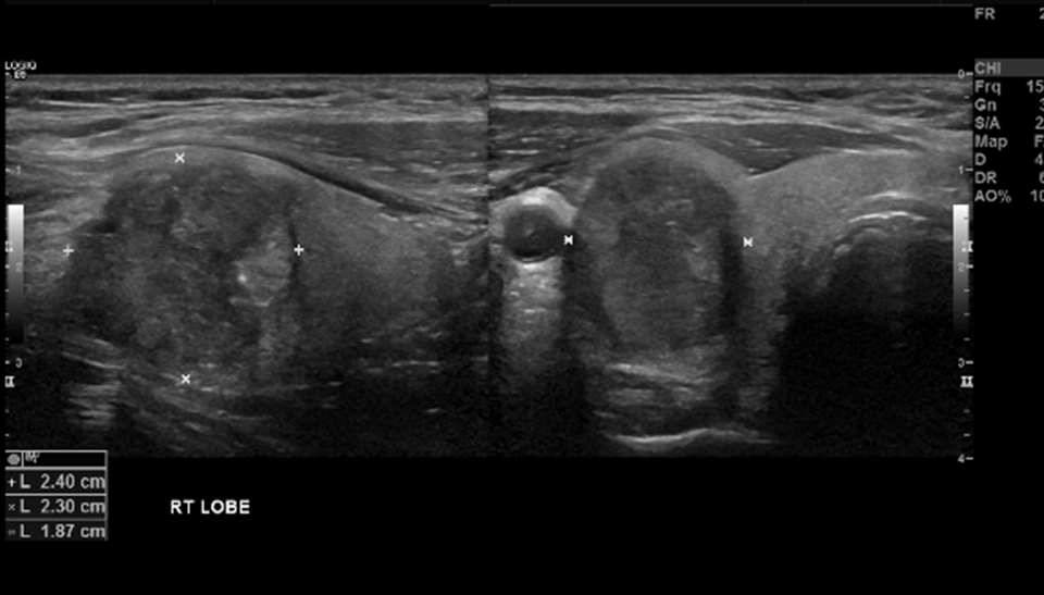 Thyroid Papillary Cancer