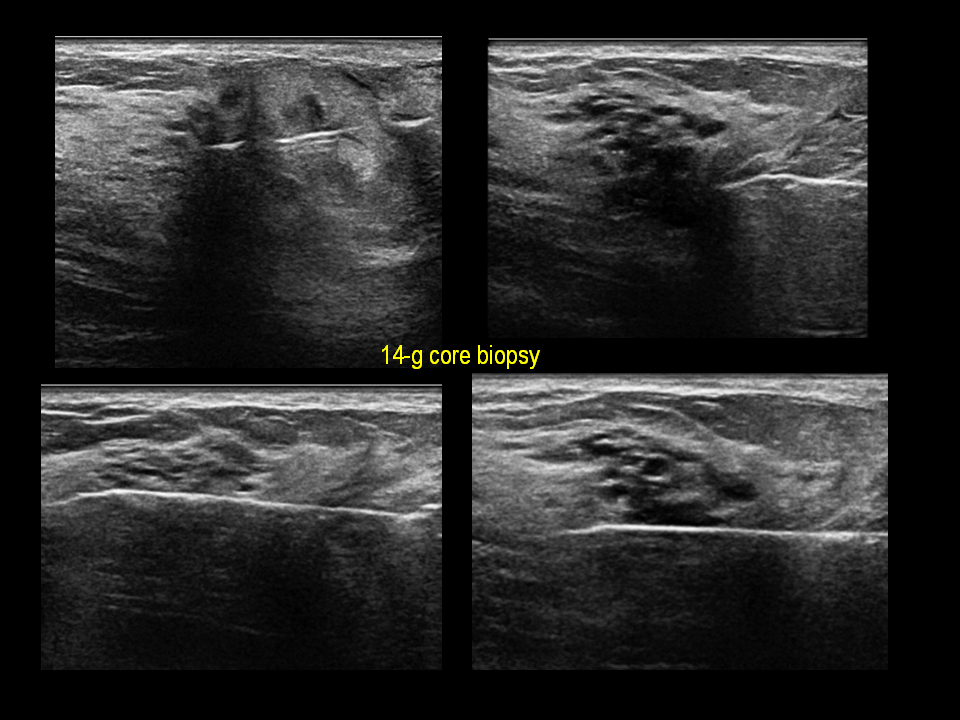 Juvenile Papillomatosis (Swiss Cheese Disease) of the Breast - Ultrasound biopsy