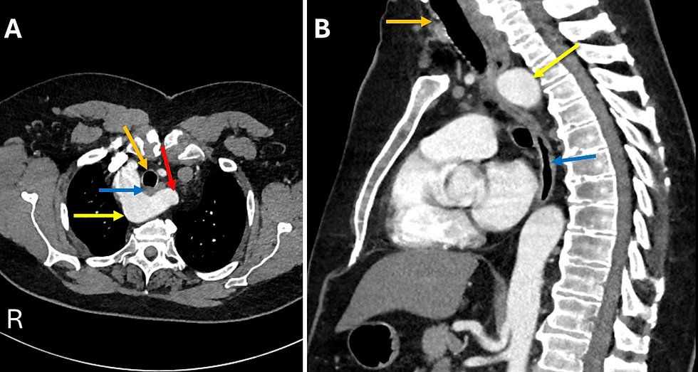 Kommerell Diverticulum Axial and Sagittal CT Scan