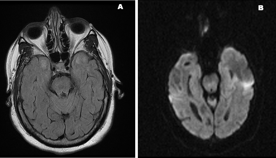 Cerebellar Hemangioblastoma