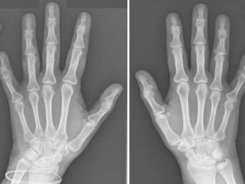 Brachydactyly Type A3