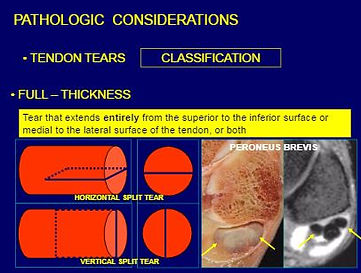 Donald Resnick Tendon Tear Slide