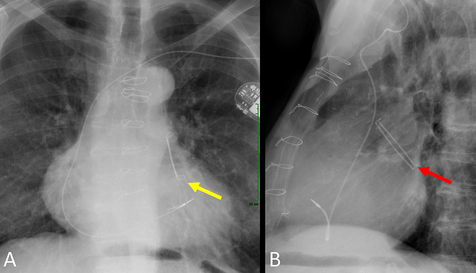 Chest xray of the AtriClip Left Atrial Appendage Exclusion System