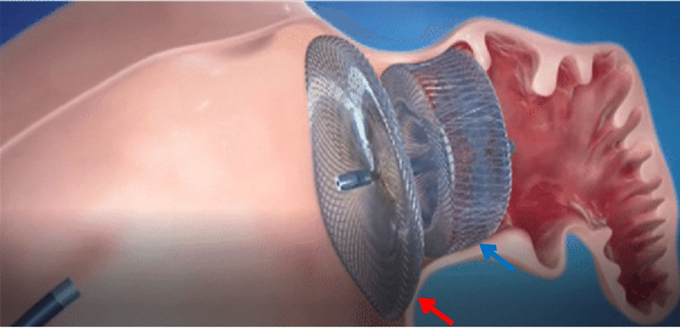 Micra intracardiac pacemaker 2