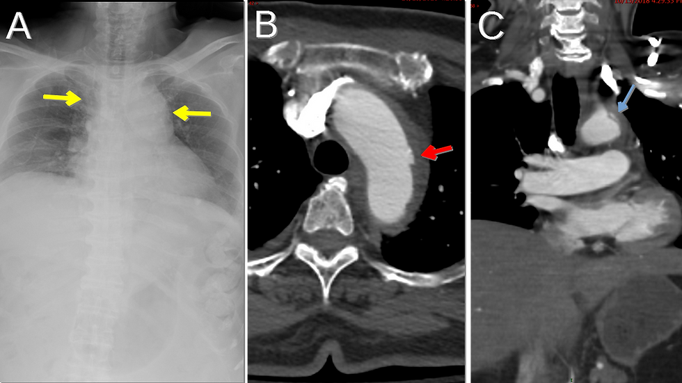 xray and CT scan Traumatic Thoracic Aortic Injury