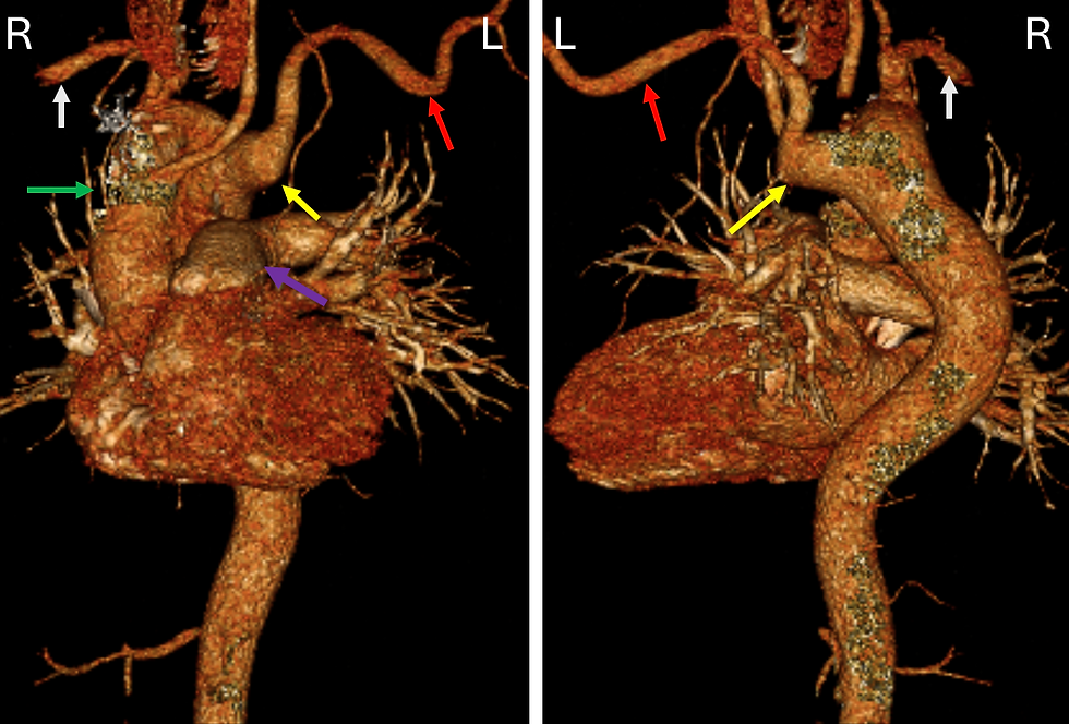 Kommerell Diverticulum 3D Volume Rendered CT Scan