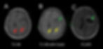 MRI of Intracranial Metastatic Melanoma