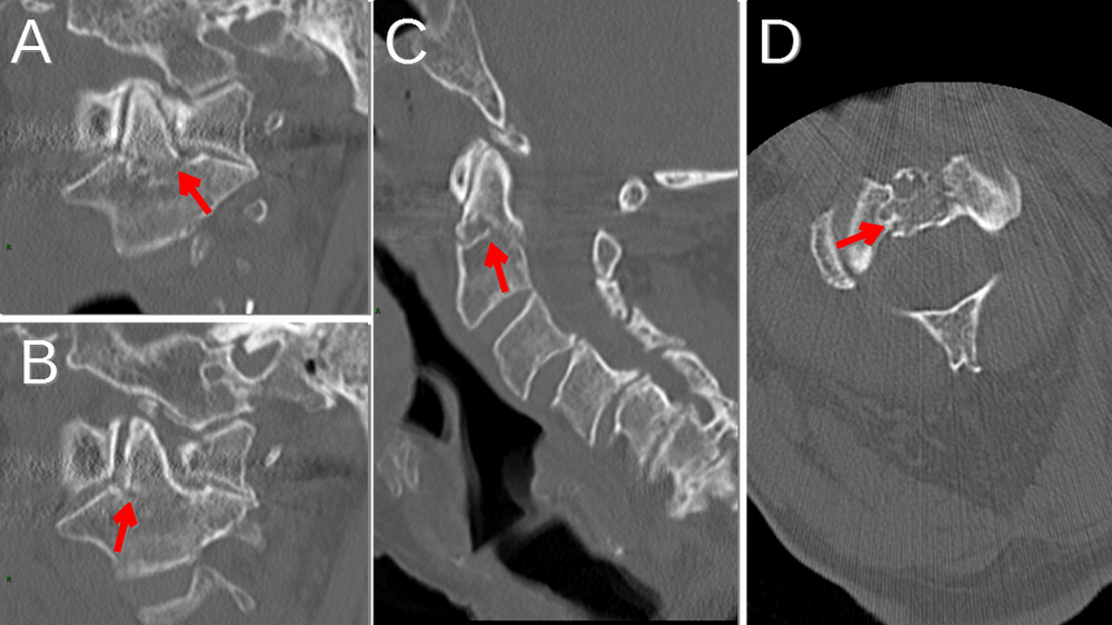 Type 3 Dens Fracture