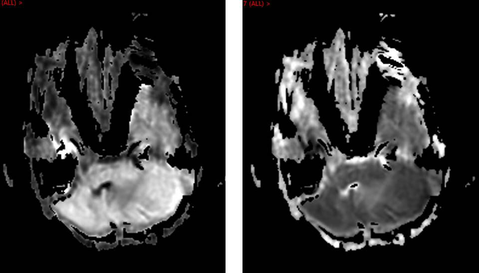 Granulocytic Sarcoma in HIV/AIDS MRI Brain