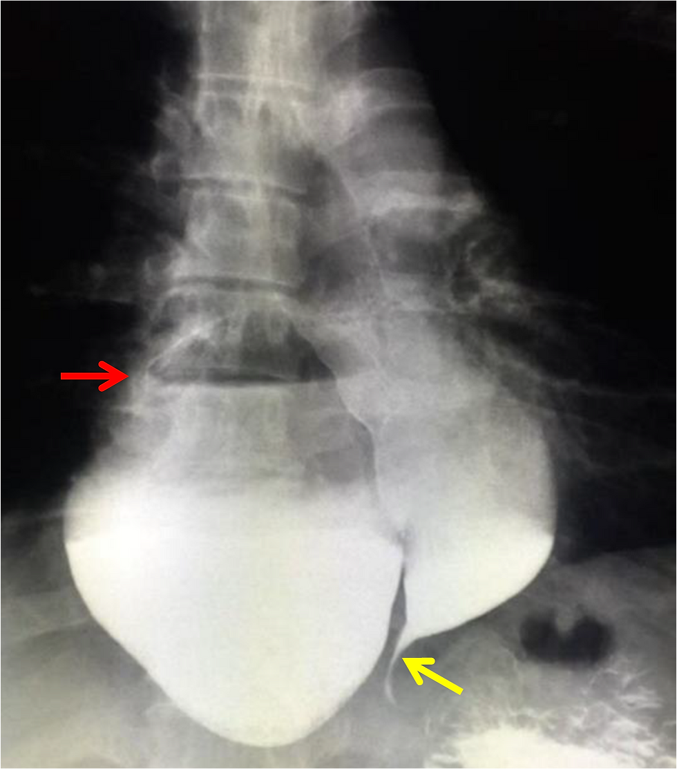 Epiphrenic Esophageal Diverticulum and Achalasia UGI