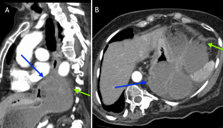 Gastric Volvulus Radiology Education Seminars International