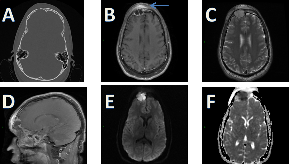 Cerebellar Hemangioblastoma