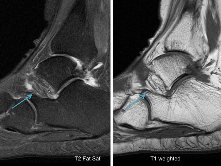 Sinus Tarsi Syndrome MRI