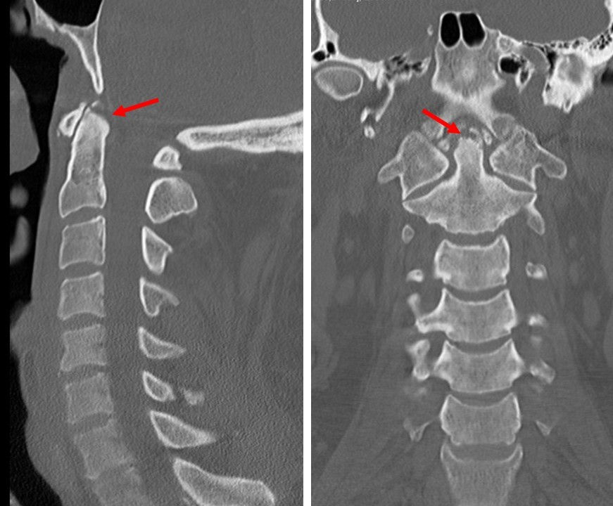 Dens Fracture Type 1 CT Scan Annotated