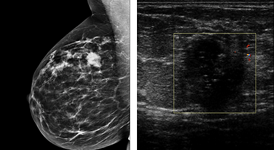 Breast Imaging