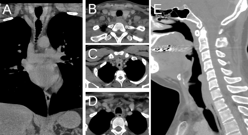 Post Intubation Tracheal Stenosis