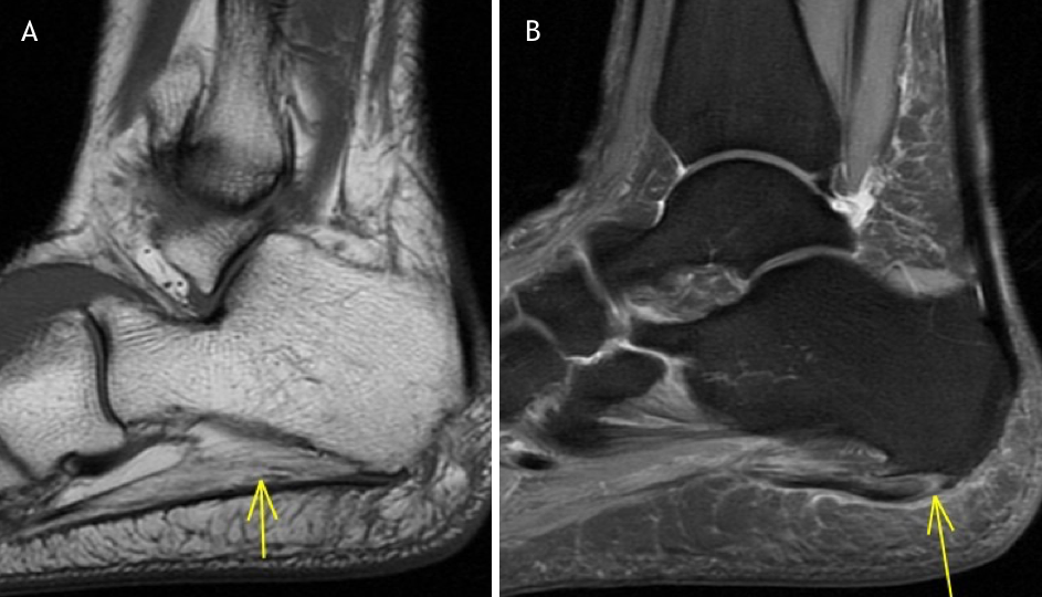 Baxter Neuropathy with Chronic Plantar Fasciosis