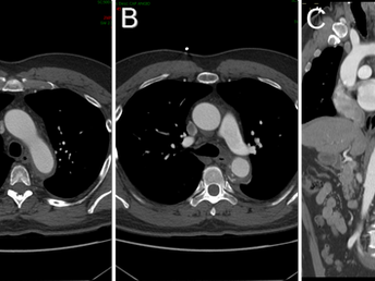 Aortic Intramural Hematoma