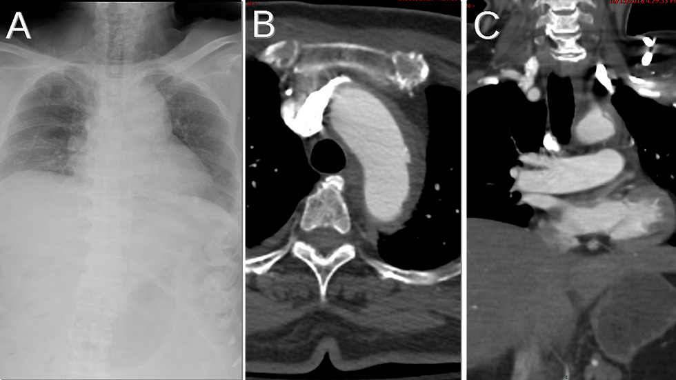 CT and Xray of Thoracic aortic injury