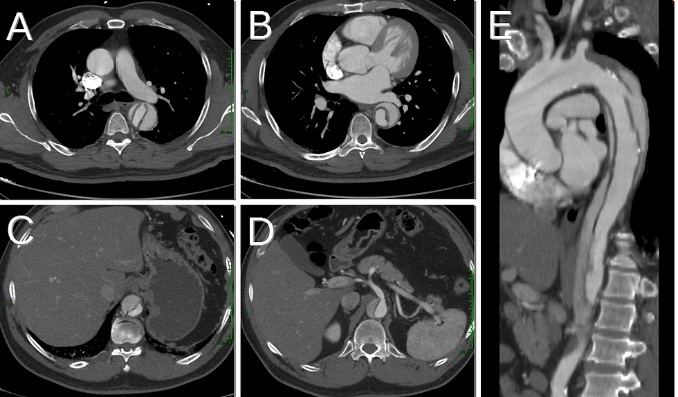 CT of Stanford B Aortic Dissection