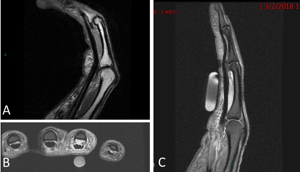 Tear of the Flexor Pulley of the Finger
