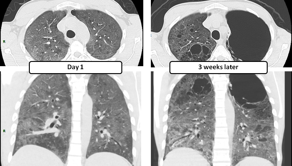 Pneumocystis Pneumonia (PCP) with Pneumatoceles | Radiology Education