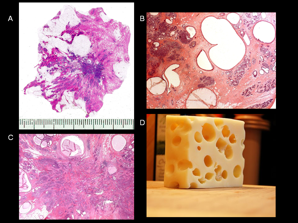 Juvenile Papillomatosis (Swiss Cheese Disease) of the Breast - Histology