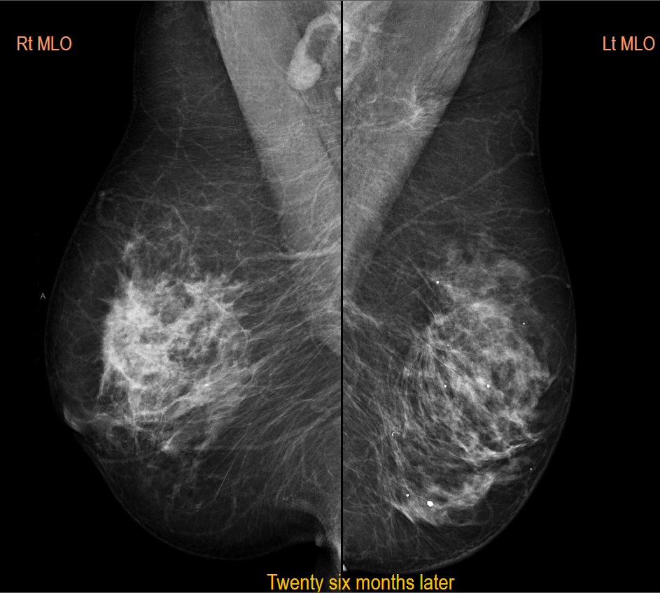 Bilateral Breast Cancer Mammogram