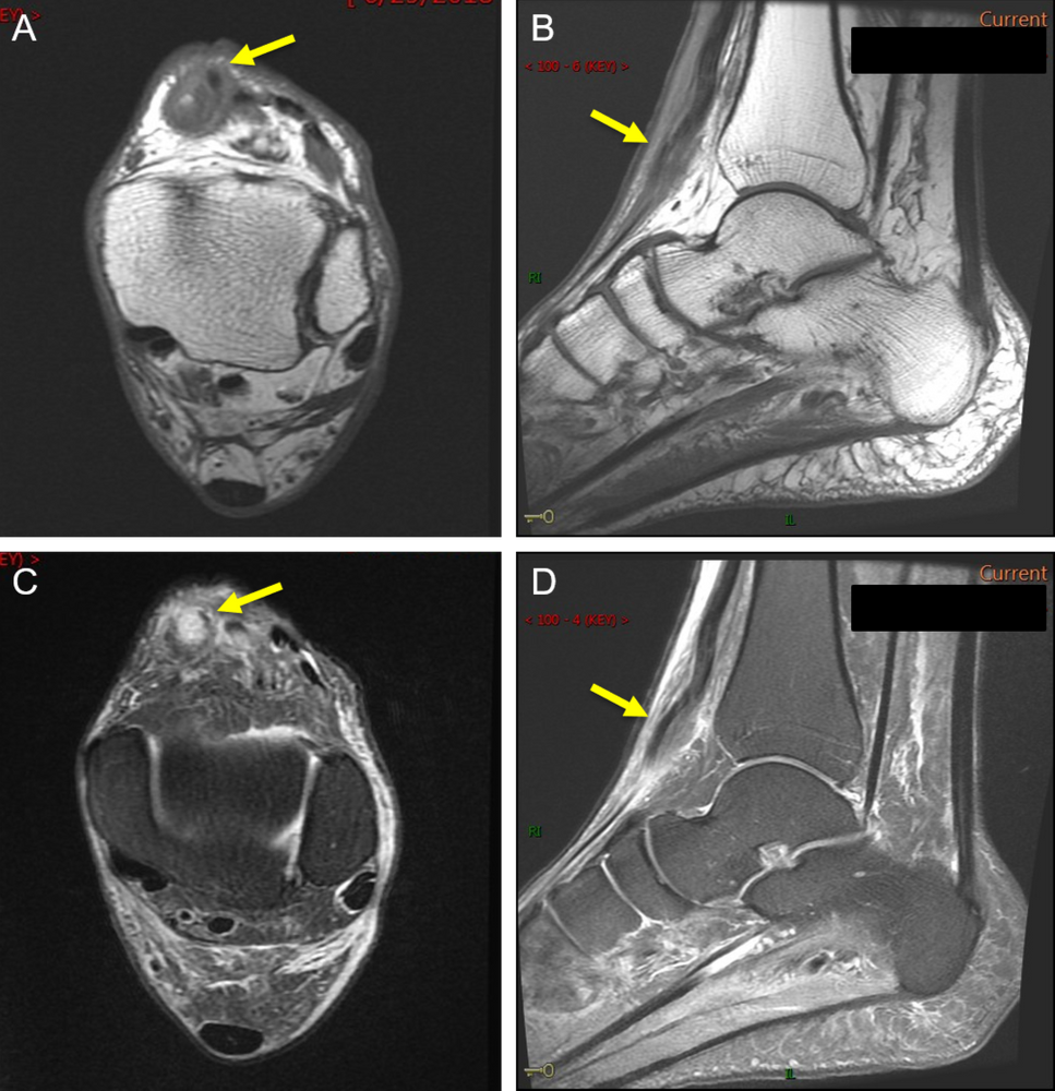 Tibialis Anterior Tendon Tear